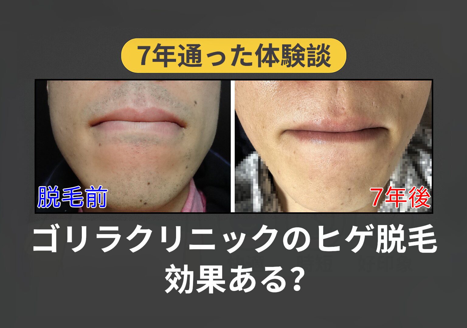 【7年通った体験談】ゴリラクリニックのヒゲ脱毛は効果ある？写真付きで解説